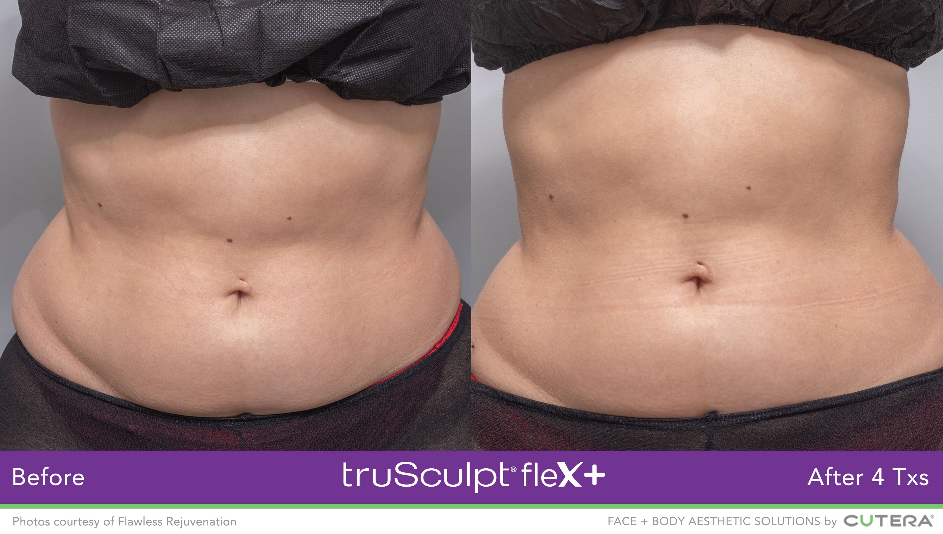 truSculpt Flex Results Image -6398c90111586
